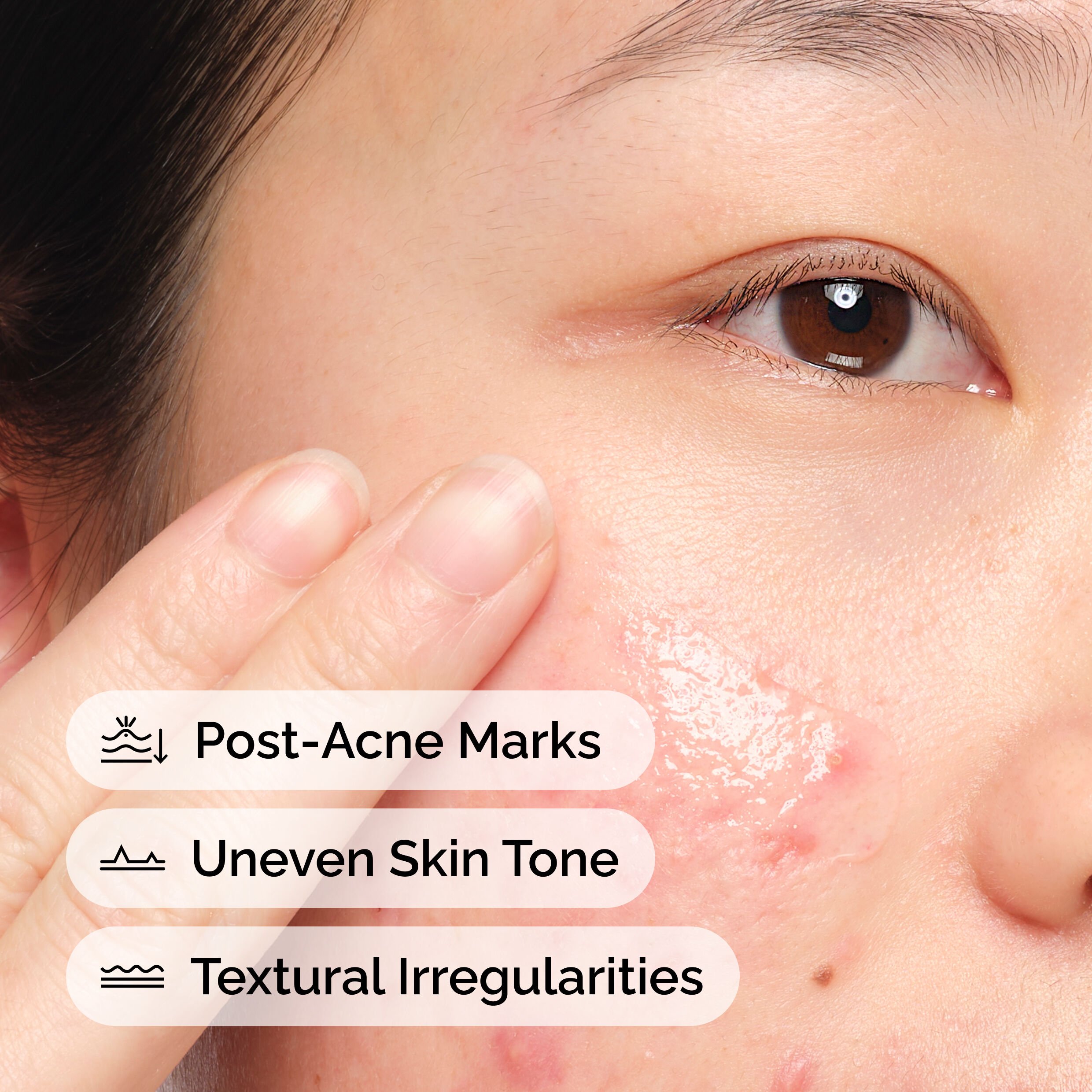 Post-Acne Marks Reduction with Aloe 2% + NAG 2% Solution 30ml - Image 2